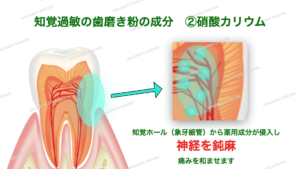 知覚過敏の歯磨き粉成分　硝酸カリウム